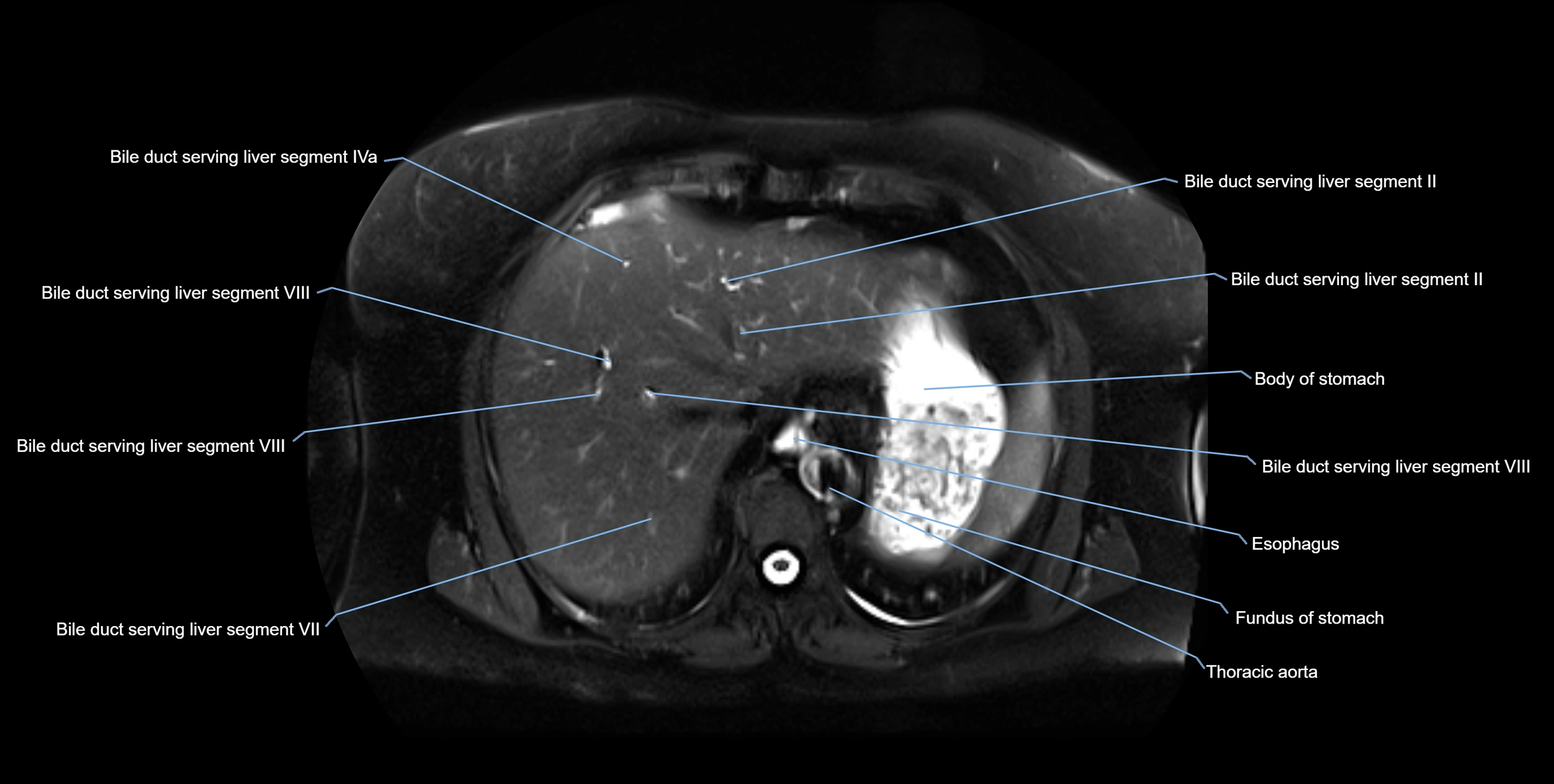 MRI MRCP axial cross sectional anatomy 3T radiology  image-img-10001-00009.webp